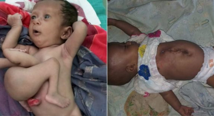 baby-born-parasitic-twin-growing-torso-saved-surgeons
