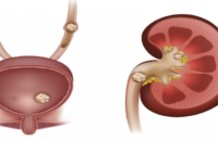 ayurveda-tips-for-kidney-stone
