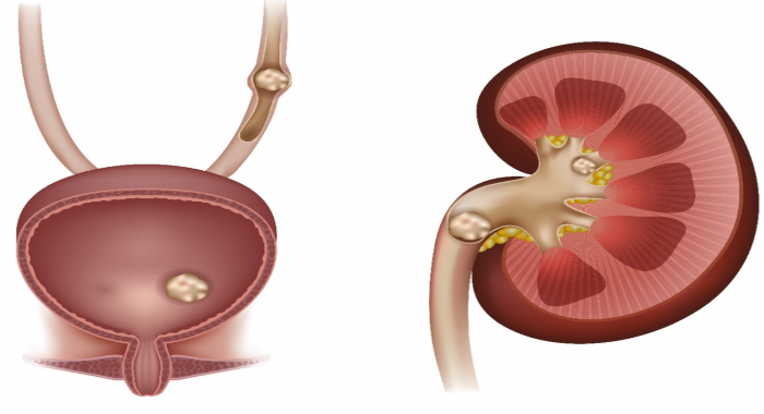 ayurveda-tips-for-kidney-stone
