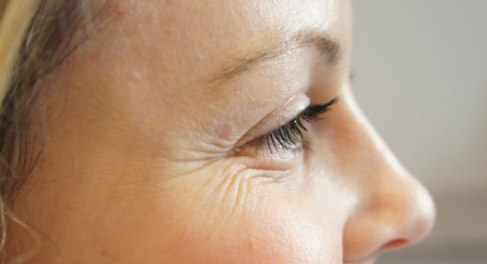 natural-remedies-for-under-eye-wrinkles