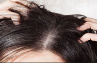 dandruff-treatment-causes-and-seborrhea-symptoms
