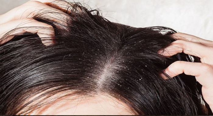 dandruff-treatment-causes-and-seborrhea-symptoms