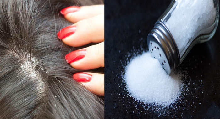 how-to-get-rid-of-dandruff-with-natural-remedies