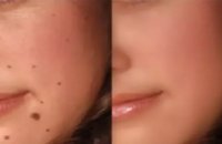 natural-remedies-to-remove-moles-warts-on-face-and-body