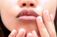 what-causes-dry-lips