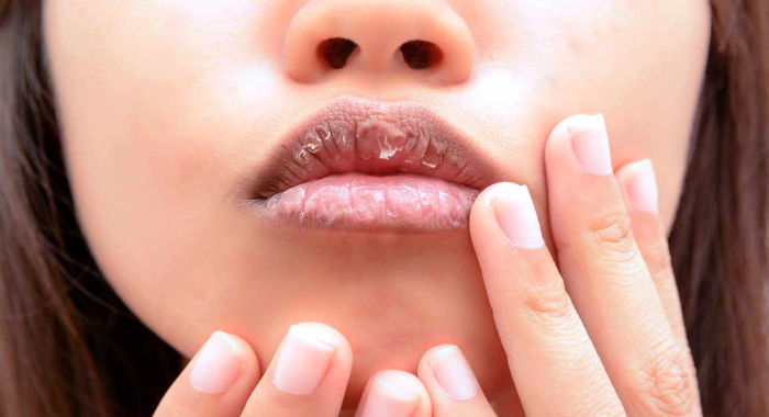 what-causes-dry-lips