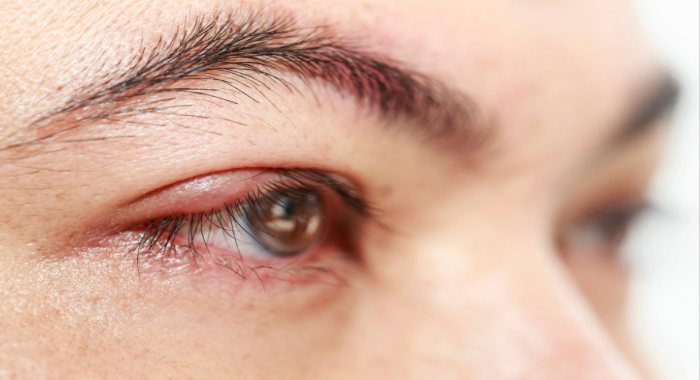 eyelid-inflammation
