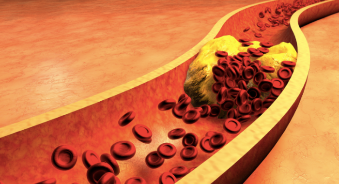 onion-raw-coconut-remedy-to-control-cholesterol