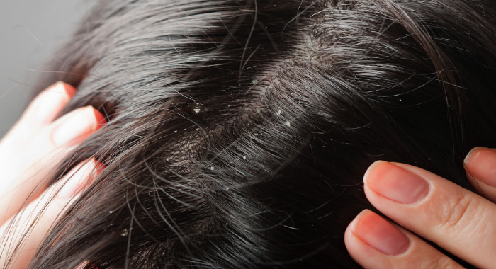 get-rid-of-dandruff-easily