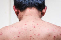 chickenpox-preventing-tips-and-treatment
