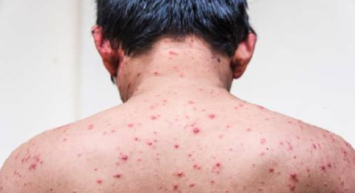 chickenpox-preventing-tips-and-treatment
