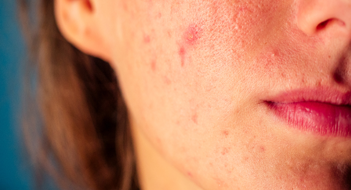 tips-to-fight-redness-on-skin