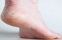 how-to-remove-flaky-skin-from-your-feet-and-legs