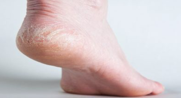 how-to-remove-flaky-skin-from-your-feet-and-legs