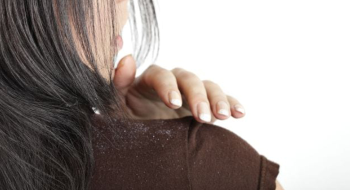 ayurveda-home-remedies-dandruff