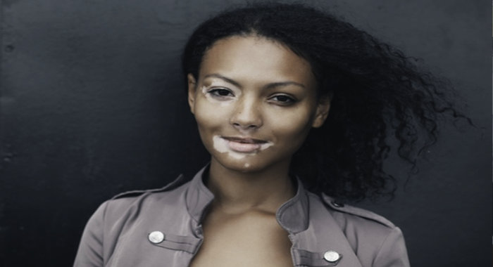 skin-pigmentation-disorders