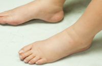 common-causes-for-leg-swelling