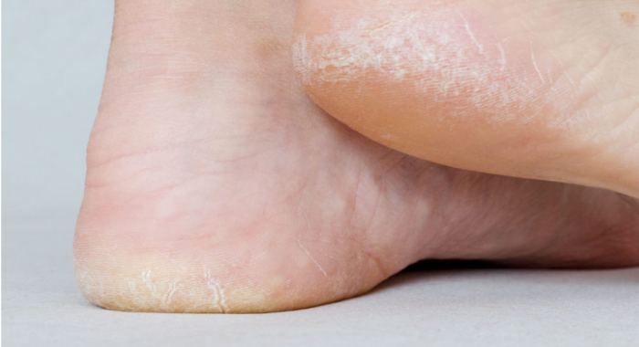 coffee-scrub-for-dry-rough-and-cracked-feet