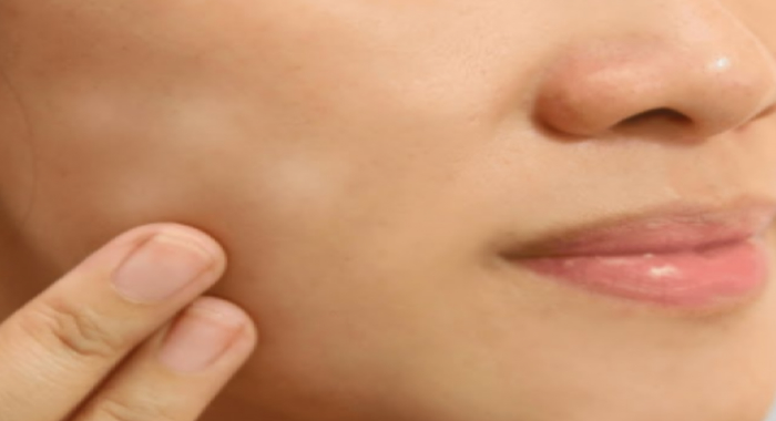 how-to-get-rid-of-white-patches-on-face