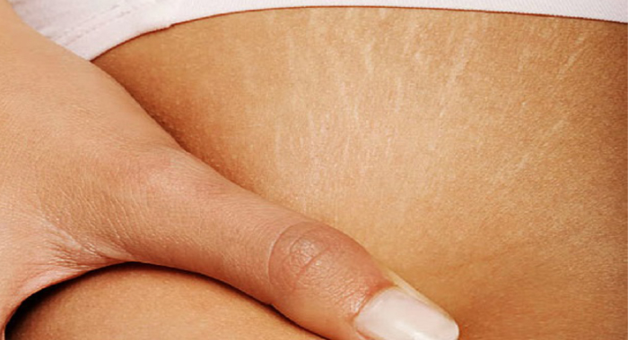 how-to-prevent-stretch-marks-while-losing-weight